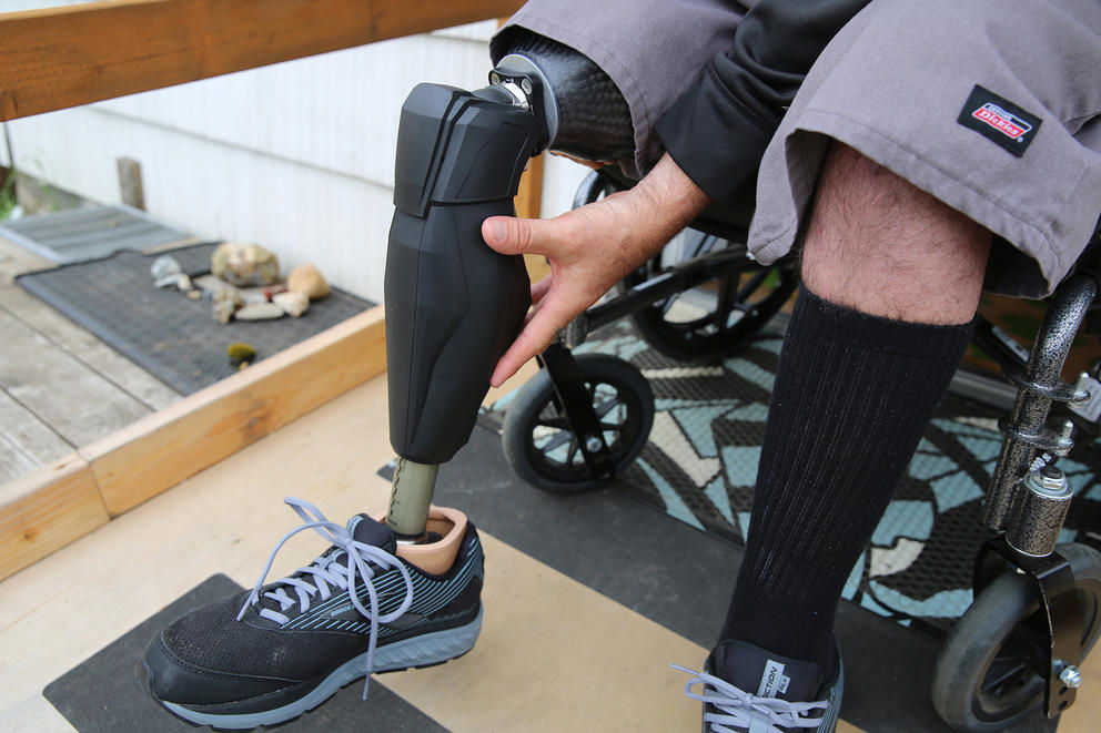 A man pointing at a prosthesis