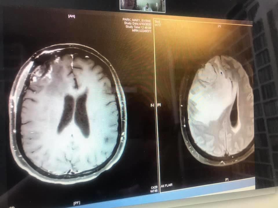 MRI of a brain tumor